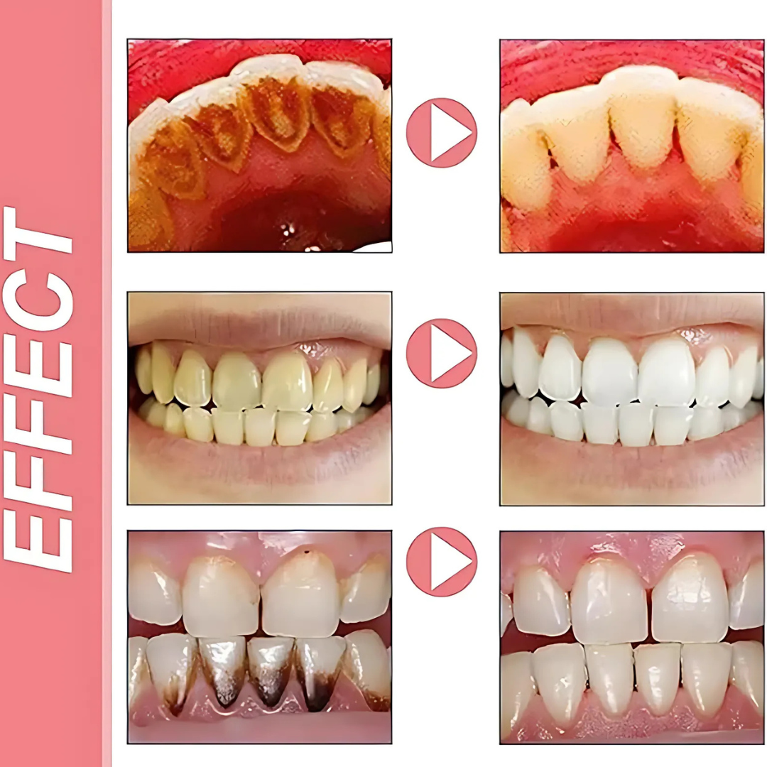 ProbioticToothpaste 1+1 GRATIS: Sanfte Zahnaufhellung Stärkende Probiotische Zahnpasta